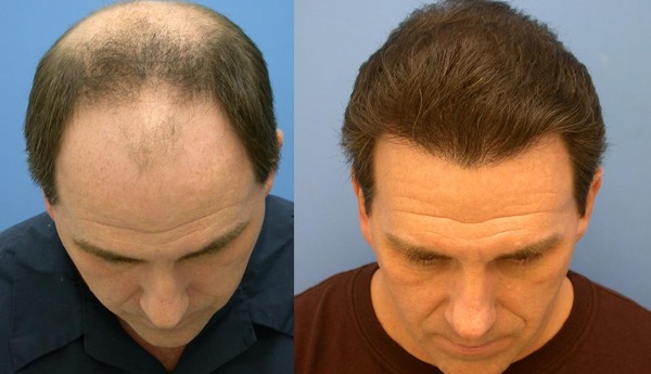 regrow hair on bald scalp